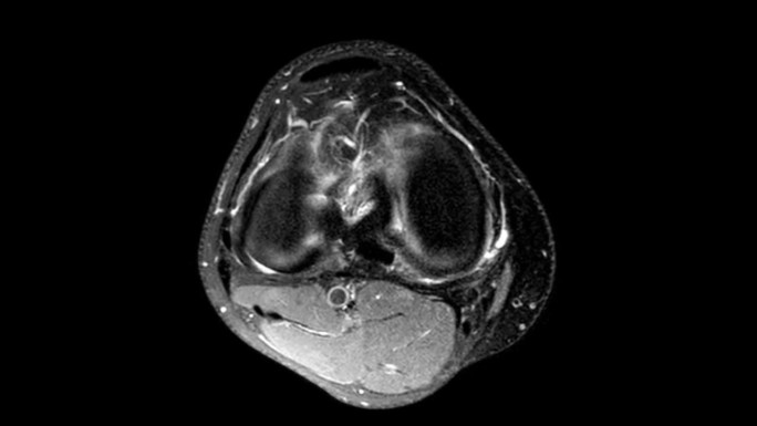 膝关节MRI。通过MRI图像滚动的动力学。右膝的磁共振成像——从上面看。运动创伤和韧带损伤的诊断。