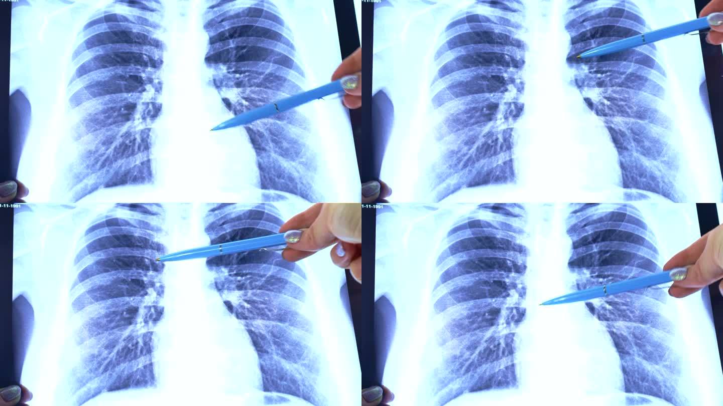 女人的手拿着蓝色的医用x射线胸部扫描光背景，用笔指着。新冠肺炎、癌症检查、肺炎、哮喘和肺结核诊断概念