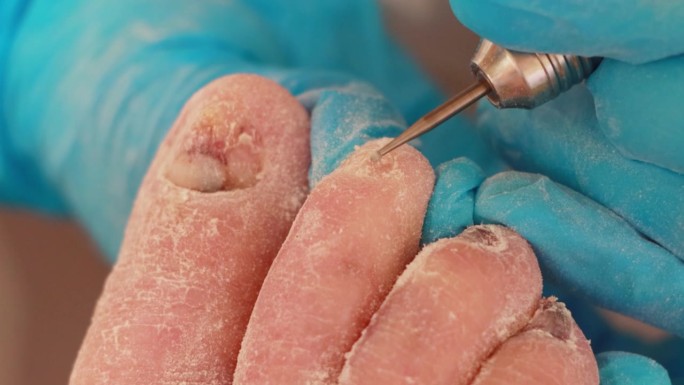 足病医生用一种特殊的工具给一位指甲酸痛的老妇人修脚。真菌和指甲的分层。特写镜头