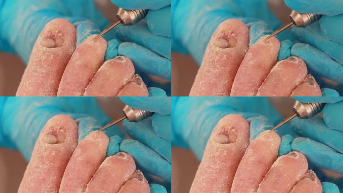 足病医生用一种特殊的工具给一位指甲酸痛的老妇人修脚。真菌和指甲的分层。特写镜头