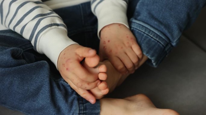 小儿皮疹、红疹、手足口病、小儿皮疹病