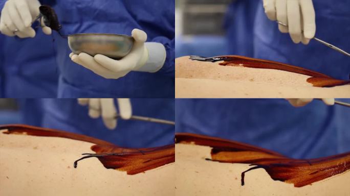 医生在手术前用医疗工具在病人身上涂抹碘酊的4K场景。