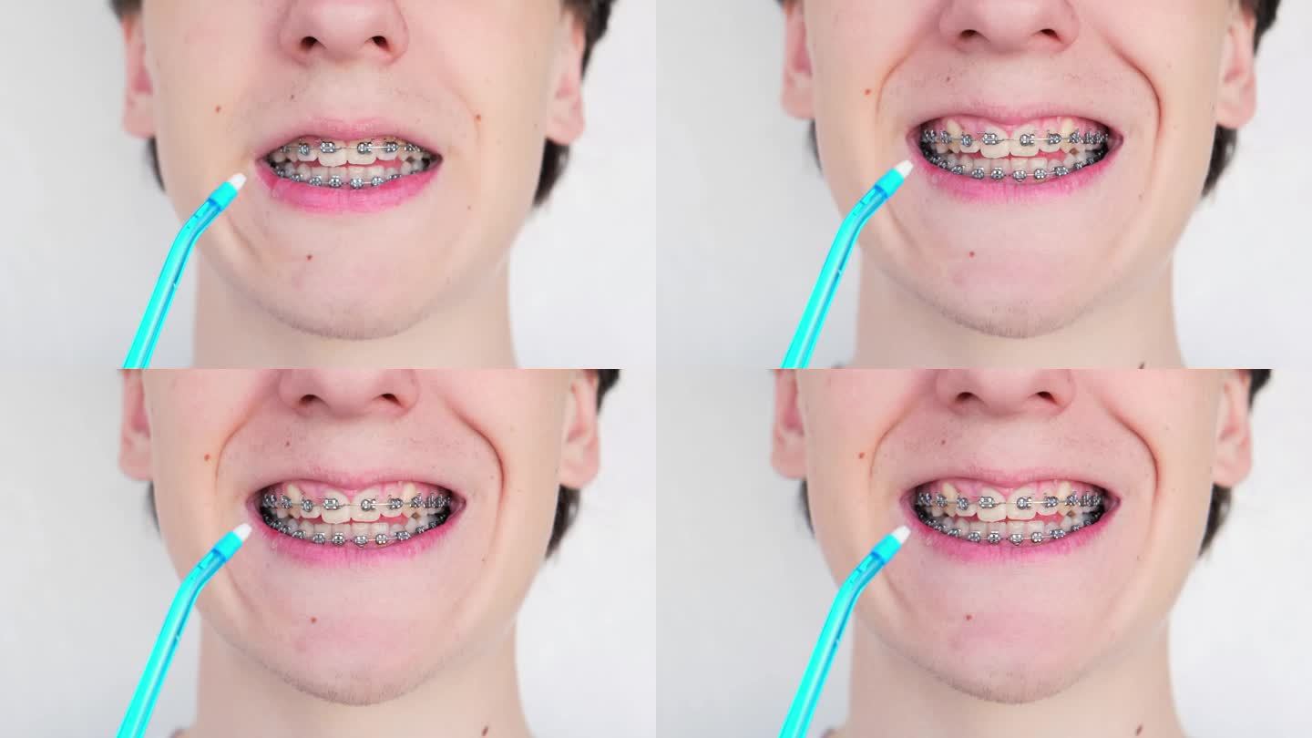 戴牙套的少年正在用口腔冲洗器清洁牙齿。