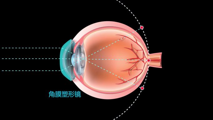 眼球对焦 角膜塑形镜