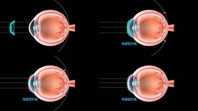 眼球对焦 角膜塑形镜