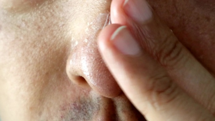 一名日本男子在晒伤的鼻子上涂药