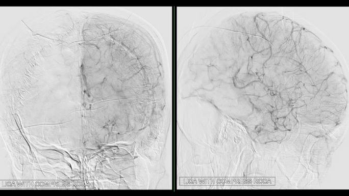 脑动脉血管造影诊断脑动脉瘤和脑动脉疾病如动脉粥样硬化(斑块)。