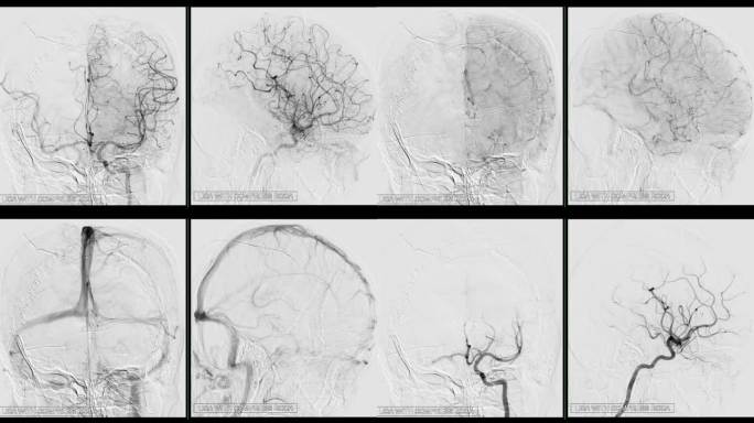 脑动脉血管造影诊断脑动脉瘤和脑动脉疾病如动脉粥样硬化(斑块)。