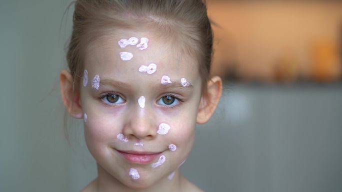 患水痘的小女孩脸上抹药膏的特写