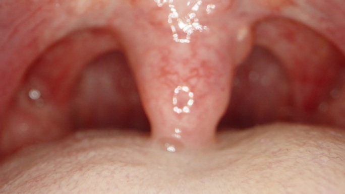 在这个男人的嘴里，是一条布满血管的大舌头。医学检查。