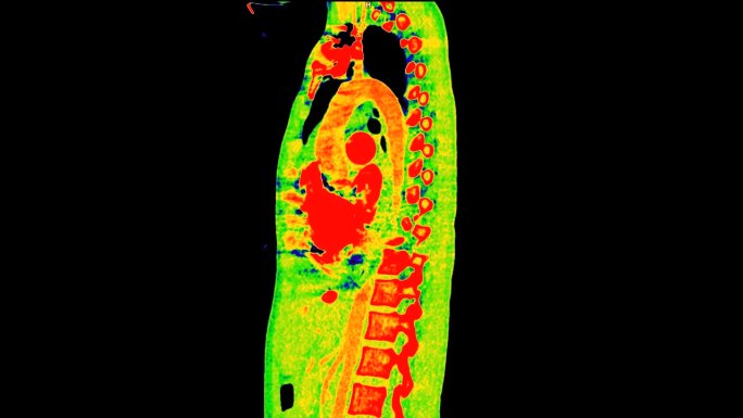彩色模式下胸部矢状位CT扫描或Pet CT扫描。