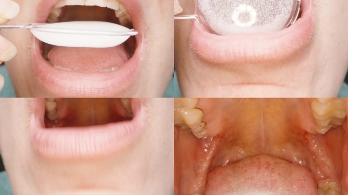 一个女人用一个量匙喝着，白色的止咳糖浆，在她的嘴里。