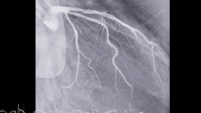 心导管检查显示冠状动脉。