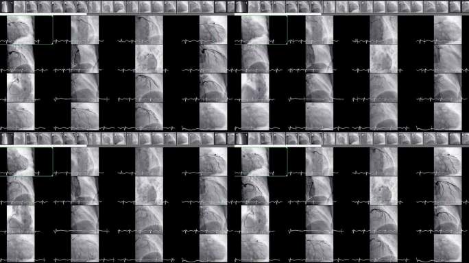 心导管检查显示冠状动脉。