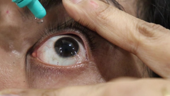 老年妇女使用眼药水，近景，妇女使用医用眼药水患有干眼症或在家治疗眼科疾病。