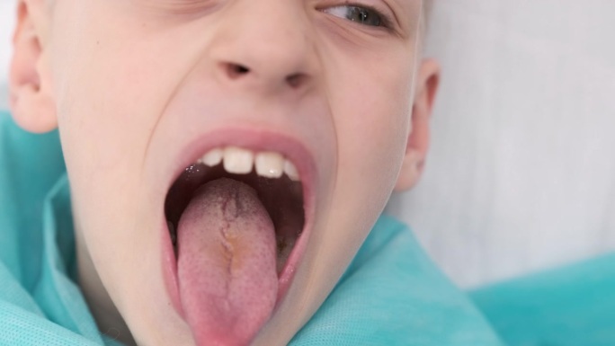 男孩张大嘴巴，伸出长长的舌头。孩子向牙医展示他的牙齿、软腭和嘴巴。嘴张得大大的，舌头尽量向外伸出，舌
