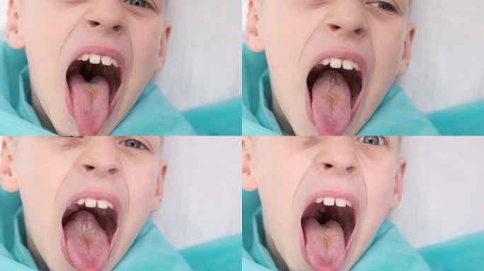 男孩张大嘴巴，伸出长长的舌头。孩子向牙医展示他的牙齿、软腭和嘴巴。嘴张得大大的，舌头尽量向外伸出，舌
