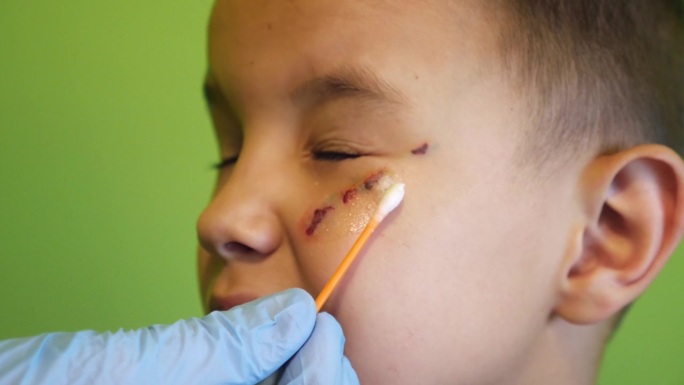 男孩脸上的伤口用泛醇泡沫治疗。治疗和愈合皮肤上的划痕。