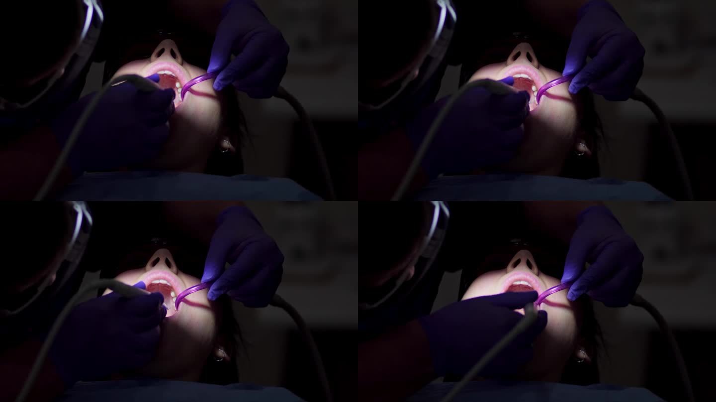 一名专业牙医用强力水射流的电动工具清洁一名女病人上牙的牙菌斑和牙石的真实镜头特写。牙科保健