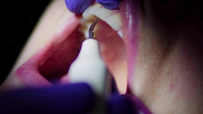 一名专业牙医用强力水射流的电动工具清洁一名女病人上牙的牙菌斑和牙石的真实镜头特写。牙科保健