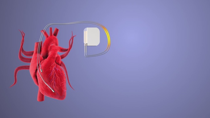 心脏和心脏起搏器的心跳波线