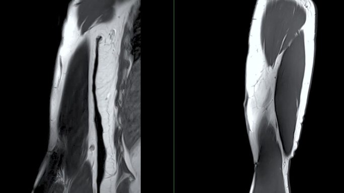 MRI左肱骨冠状位和矢状位T2W对骨肿瘤的诊断价值。