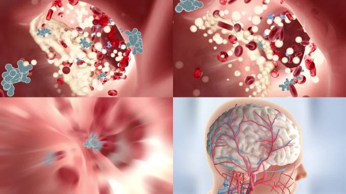 栓塞 血管堵塞 高血脂 高血压  溶栓
