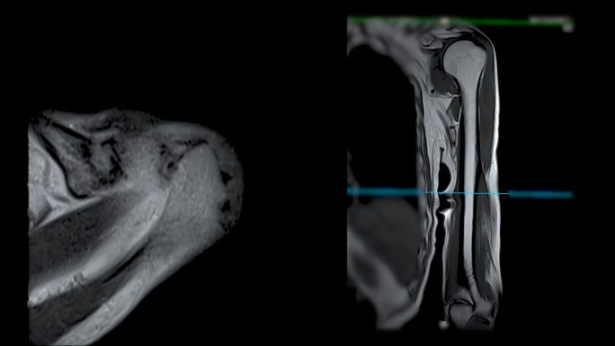 MRI左肱骨轴位及冠状位T2W对骨肿瘤的诊断价值。