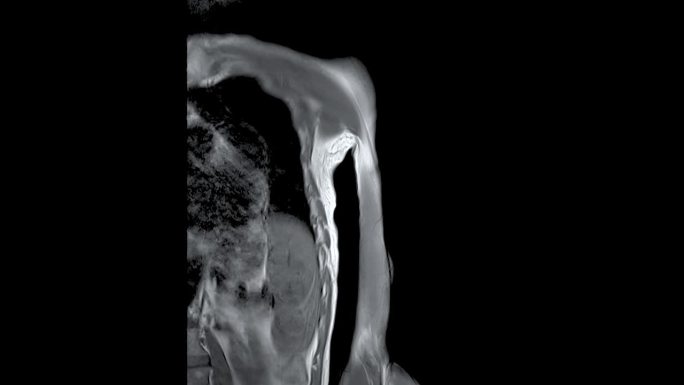 MRI左肱骨冠状位T2W对骨肿瘤的诊断价值。