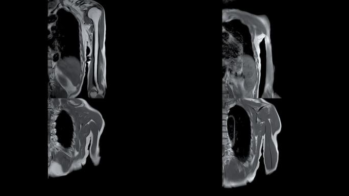 MRI左肱骨冠状位T2W对骨肿瘤的诊断价值。
