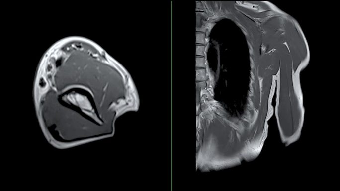 MRI左肱骨轴位及冠状位T2W对骨肿瘤的诊断价值。