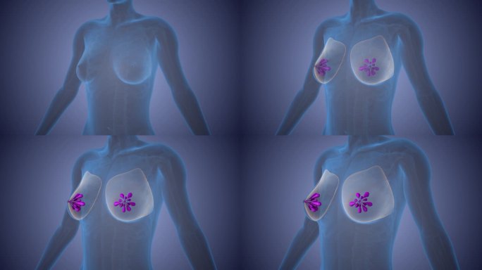 乳腺癌细胞的概念可视化
