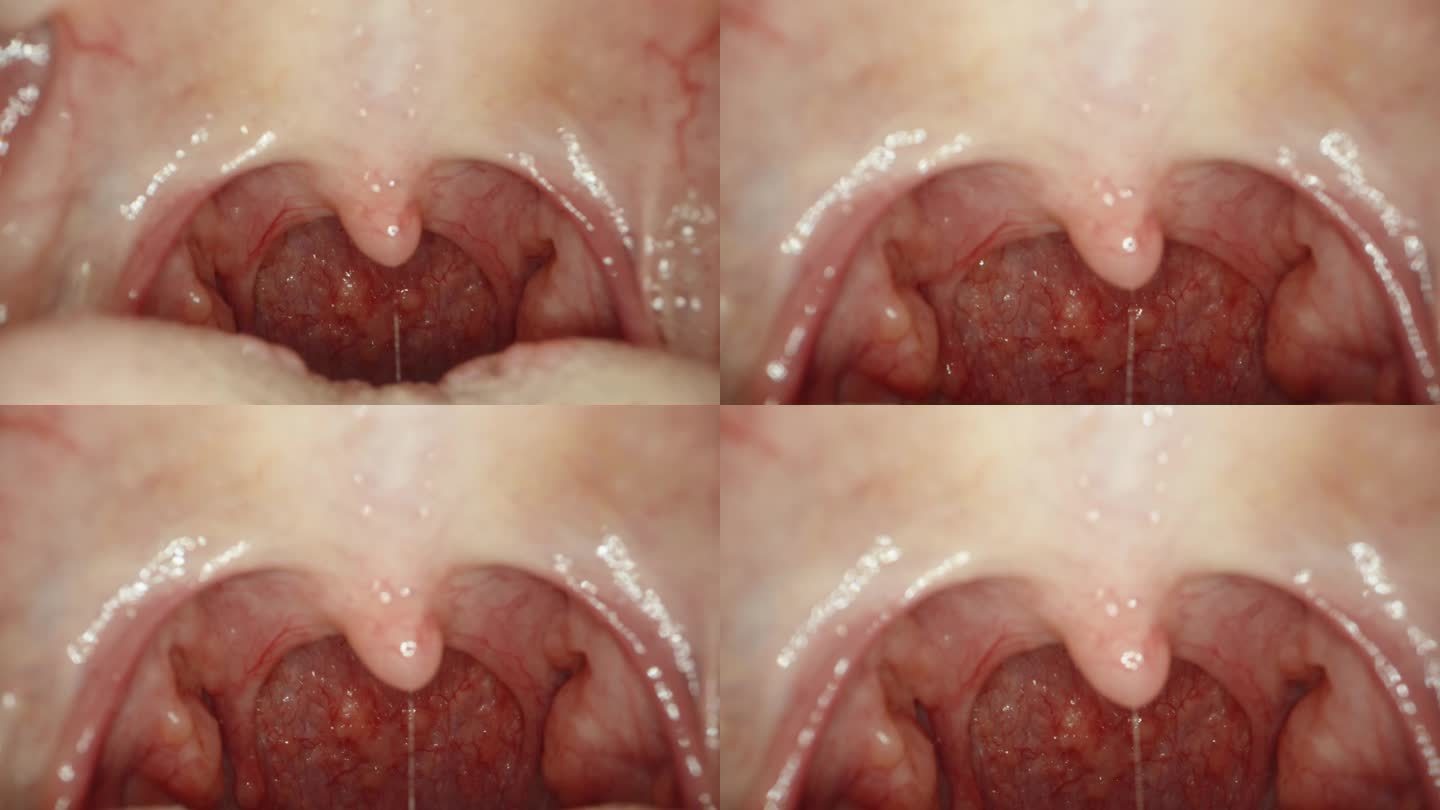 咽喉发炎妇女在口腔内生病时喉咙发炎和发红探针进入口腔，宏观的。