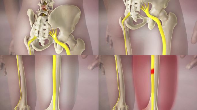 坐骨神经腿痛3D动画