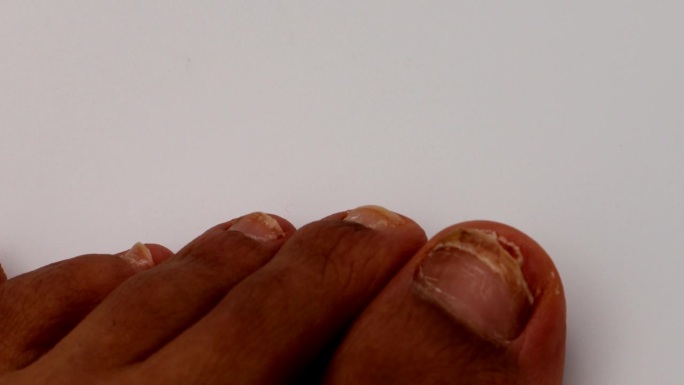 放大受伤的脚趾甲脚指甲损坏