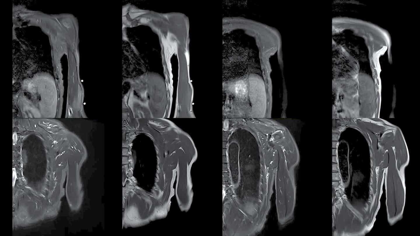 MRI左肱骨冠状位T2FS和T2对骨肿瘤的诊断价值。