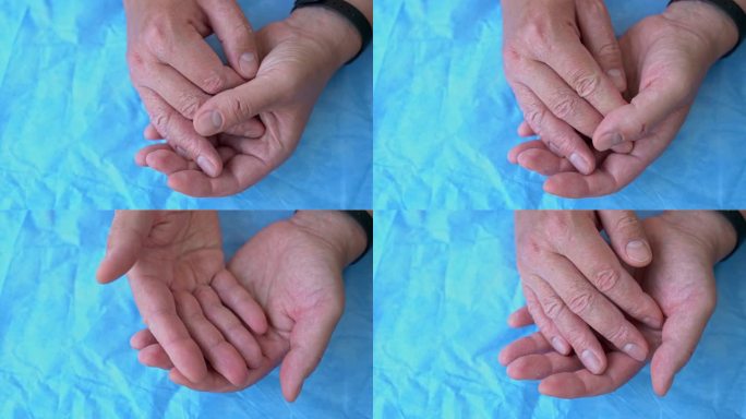男性手部及手指湿疹性皮炎特写。皮肤剥离和脱屑的男子手在蓝色背景。手部过敏体质强。皮肤发红，皲裂，起水