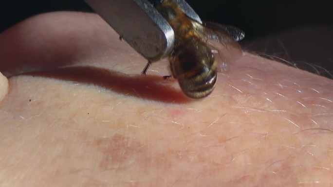 蜂疗。在镊子的帮助下，蜜蜂被放在一个人的皮肤上，故意强迫它蜇人。蜜蜂蛰伤是为了健康和治疗。用蜂毒治疗