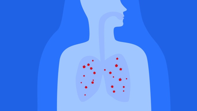 肺部疾病或呼吸系统、冠状病毒的动画。肺部的细菌，说明疾病的过程