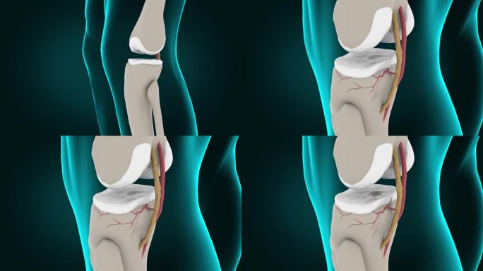 膝关节骨刺三维动画