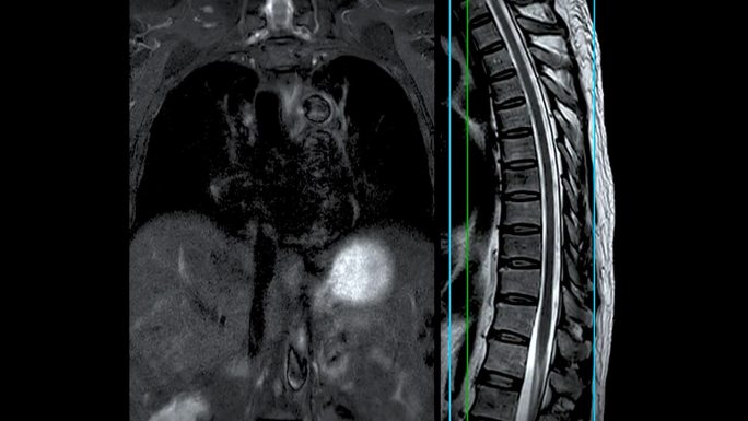 MRI T-L脊柱或胸椎冠状位和矢状位T2技术与参考线诊断脊髓压迫。