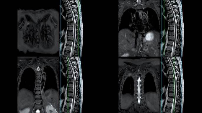 MRI T-L脊柱或胸椎冠状位和矢状位T2技术与参考线诊断脊髓压迫。