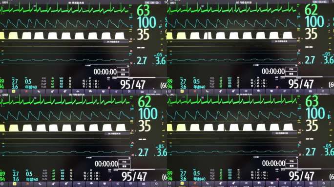 医疗监控屏幕：心电图与生命体征数据展示