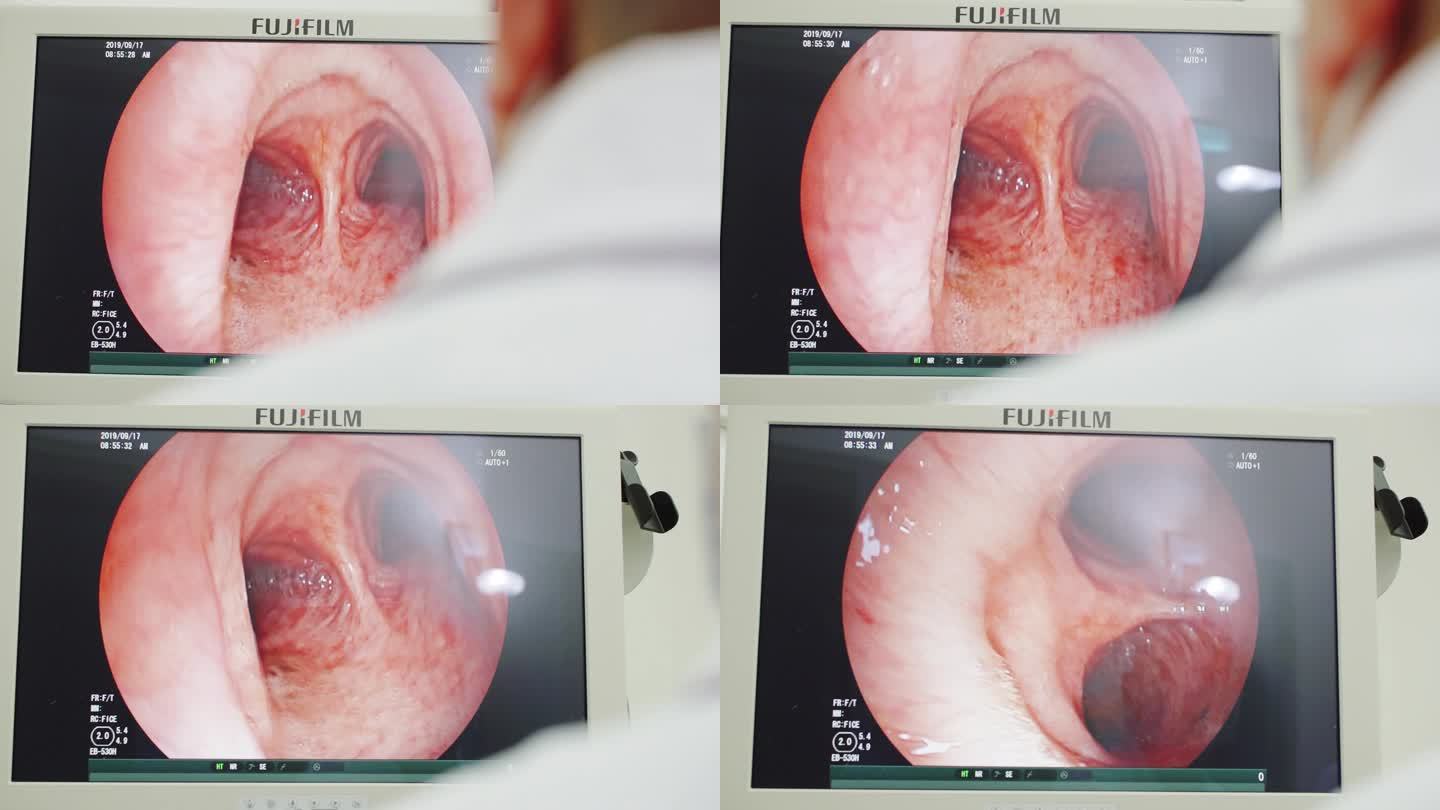 高端纤支镜内窥镜口腔扁桃体炎气管咽喉疾病