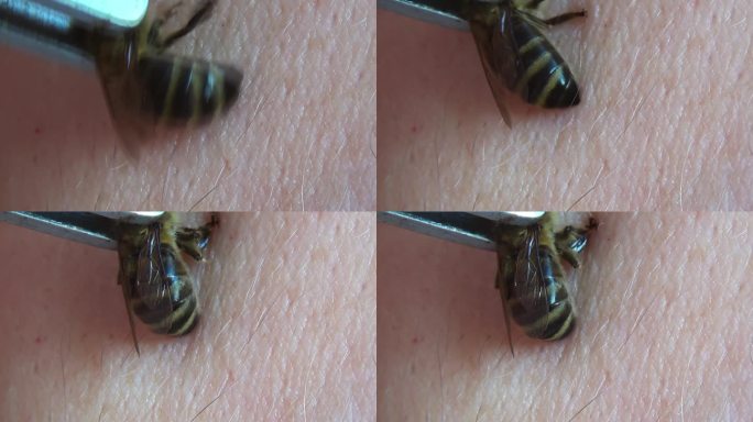 蜂疗。在镊子的帮助下，蜜蜂被放在一个人的皮肤上，故意强迫它蜇人。蜜蜂蛰伤是为了健康和治疗。用蜂毒治疗