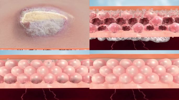 破损修复 表皮 皮肤 粘膜溃疡 细胞再生