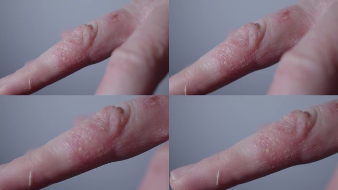 可怕丑陋的皮肤，手和手指感染疾病，结痂，干燥，发红