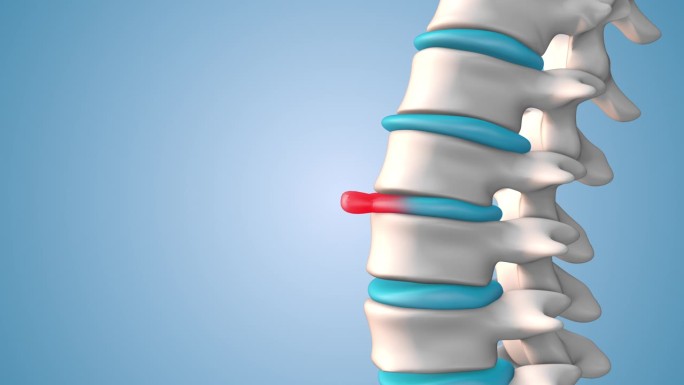 人脊柱膨出或椎间盘突出