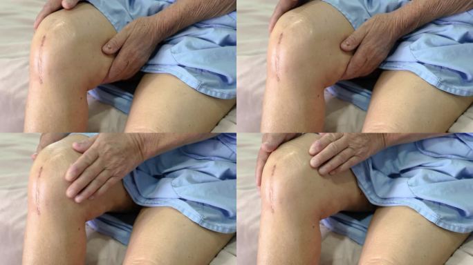 亚洲老年妇女患者显示疤痕手术全膝关节置换术缝合伤口手术关节置换术在医院床上，健康强医学观念。