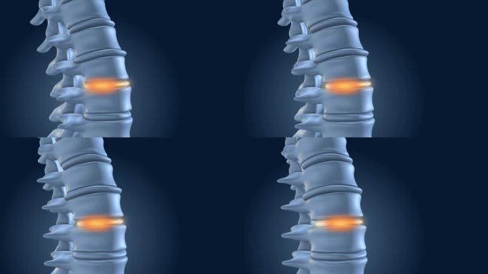 腰椎植入物稳定脊柱